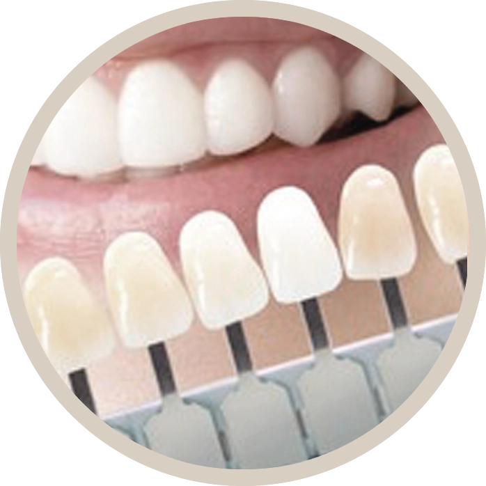 Carillas Estéticas para una sonrisa perfecta en Berga.