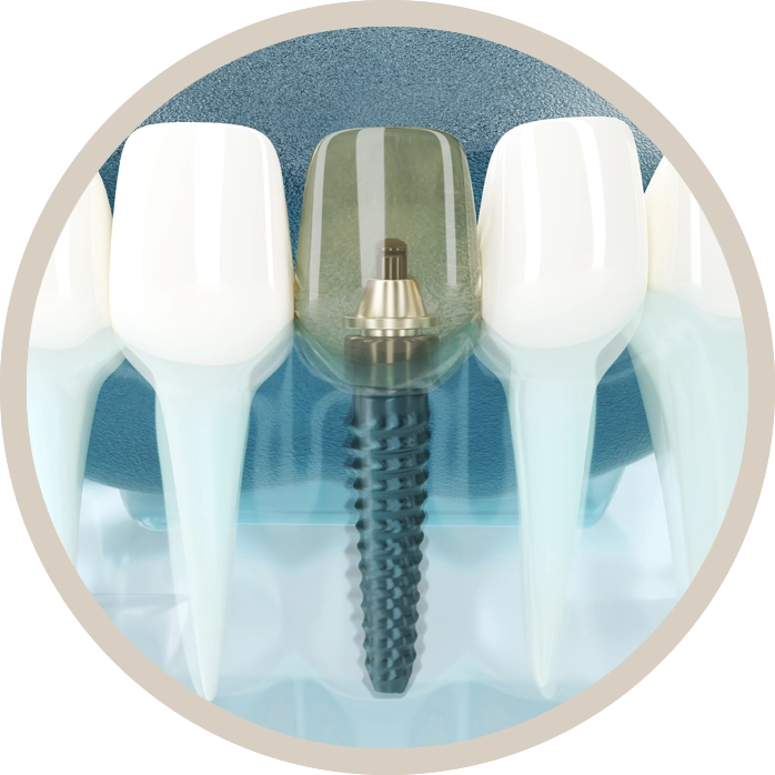 "Implantes Dentales de alta calidad en Clínica Dental Berguedà, Berga.