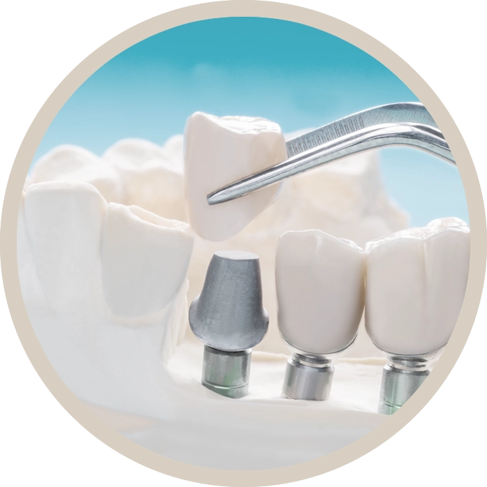 Prótesis Dental Personalizada en Berga - Funcionalidad y Estética.